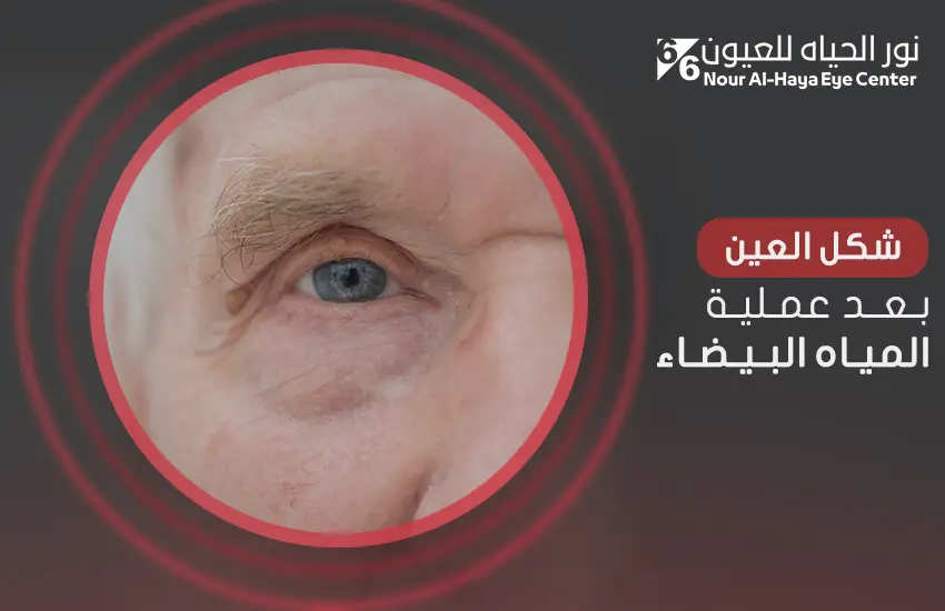 شكل العين بعد عملية المياه البيضاء