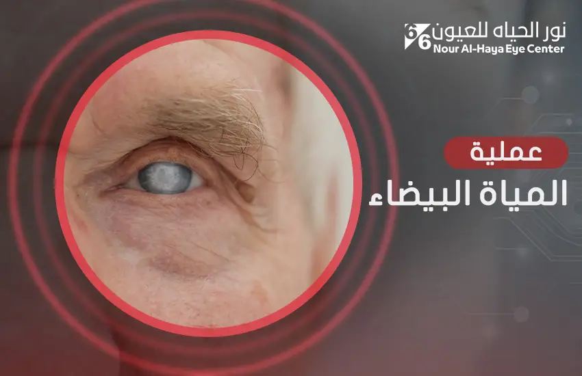 عملية المياه البيضاء