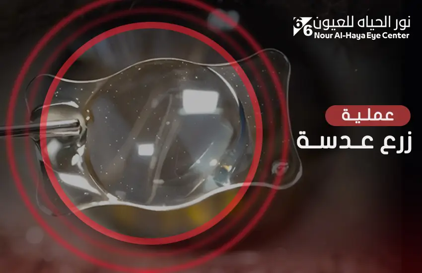 عملية زرع عدسة