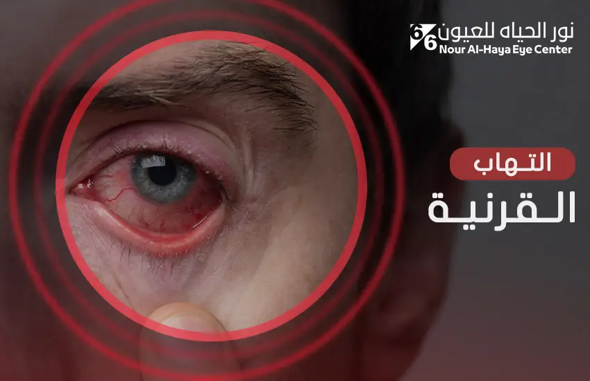 التهاب القرنية