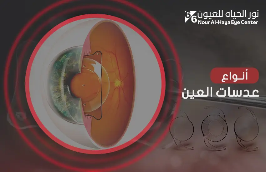 أنواع عدسات العين