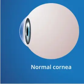 قرنية العين بالصور