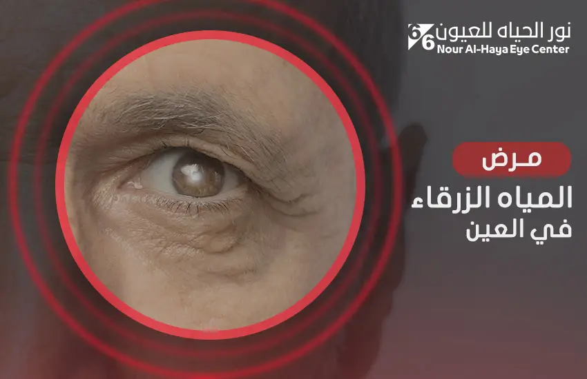 مرض المياه الزرقاء في العين