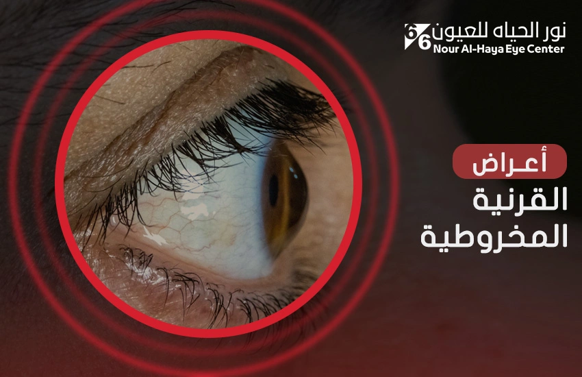 أعراض القرنية المخروطية