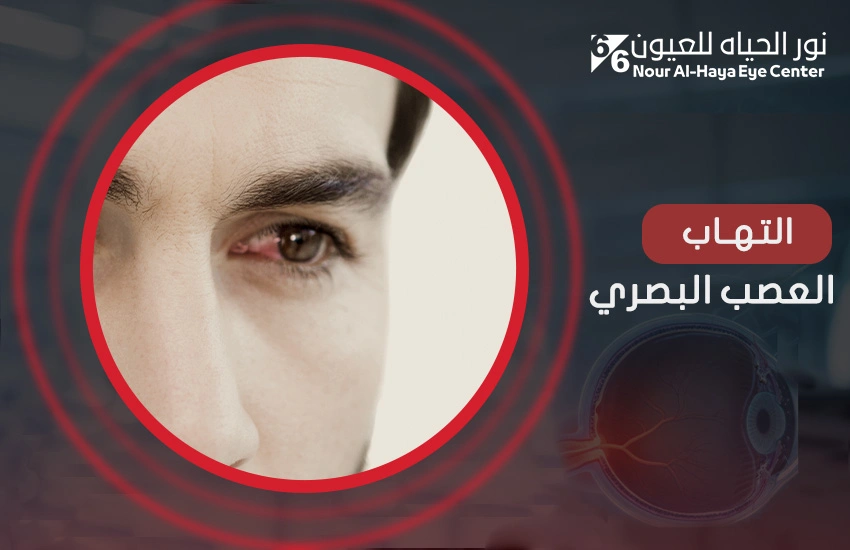 التهاب العصب البصري