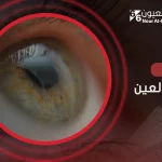 سعر قرنية العين: ما يجب أن تعرفه قبل زراعة القرني