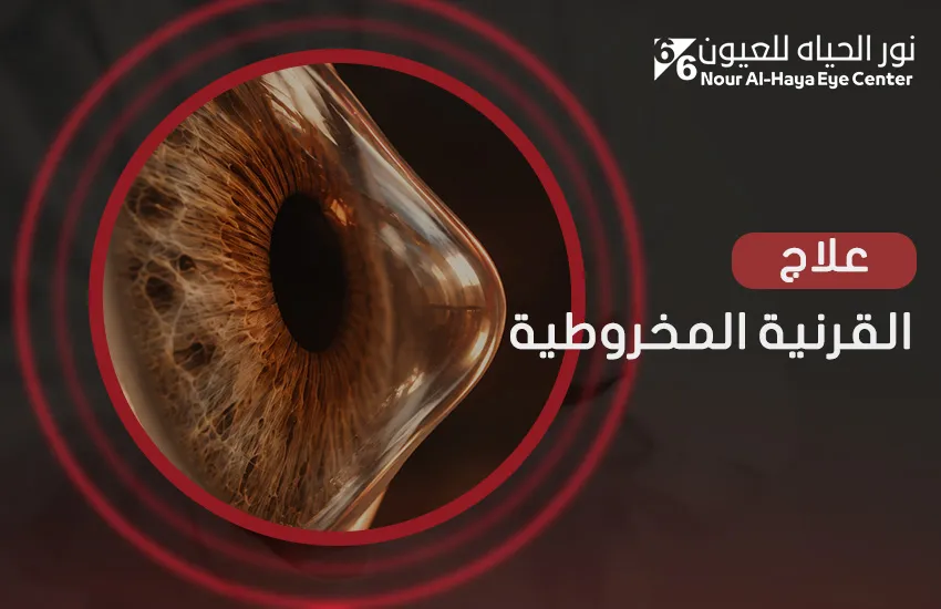 كيفية علاج القرنية المخروطية حسب مراحل المرض