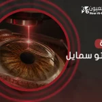 خطوات عملية الفيمتو سمايل والنتائج من الإجراء
